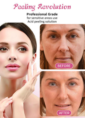 30 ml de sérum de peeling de la peau / sélection de liquide de qualité professionnelle pour solution d' exfoliation de la peau du visage
