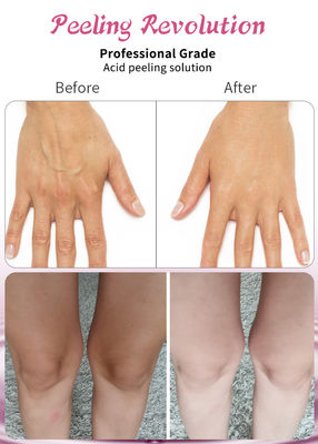 Solution de peeling acide de qualité professionnelle Liquid Set pour l' exfoliation du visage