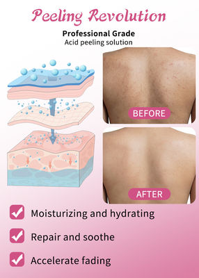 Sérum exfoliant Solution de peeling de la peau Détoxifiant de l' acné Soins de la peau Peeling de la peau 30 ml