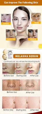 Le sérum meso Melasma de tache de rousseur de retrait de Microneedling de sérum de soins de la peau pèlent le blanchiment