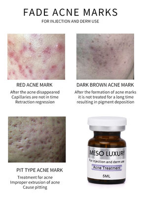 Les taches rouges de Mesotherapy de la jeunesse d'injection de luxe de sérum pèlent le traitement d'injection d'acné